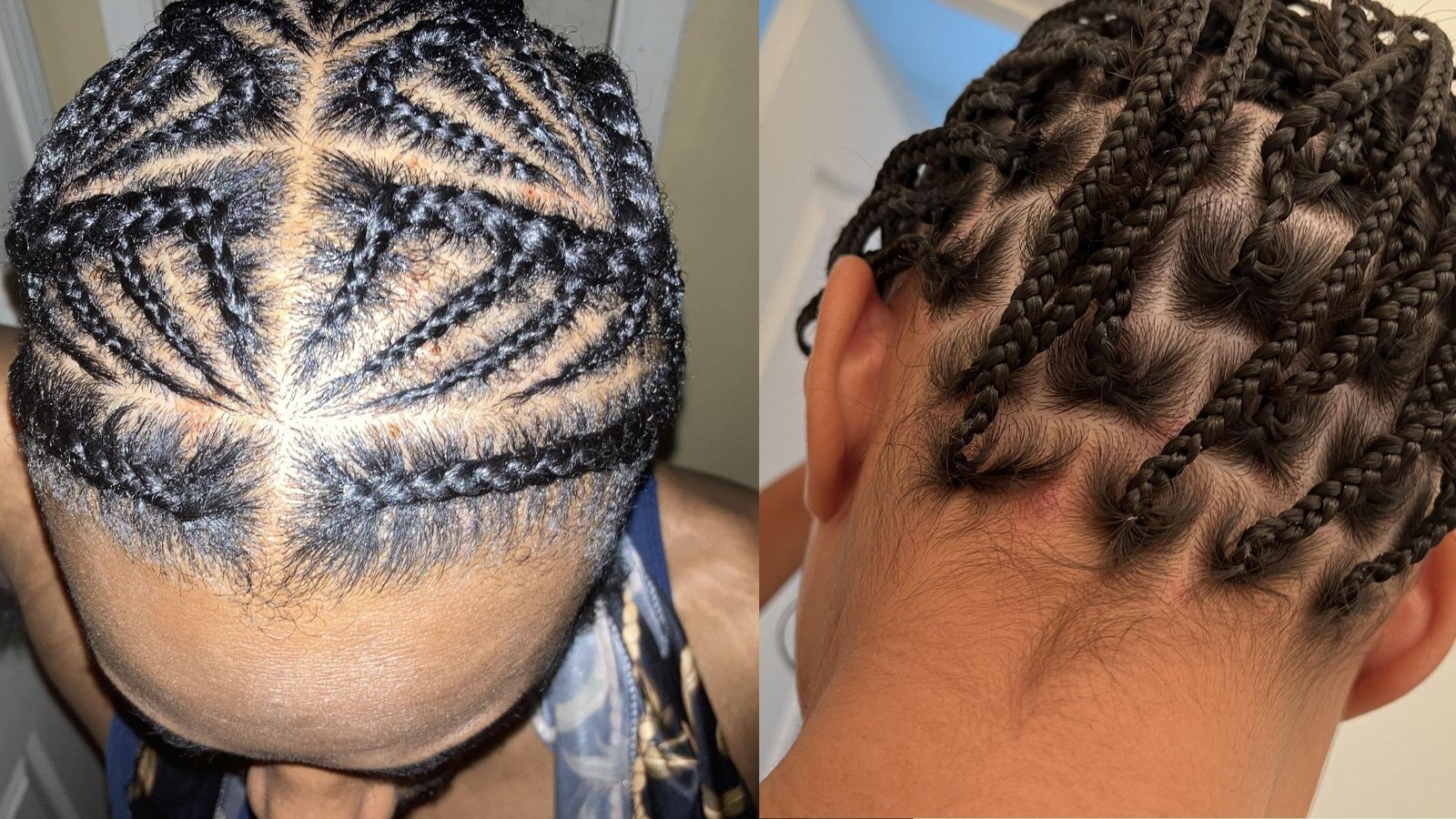 Braid Bumps on Scalp? Proven Ways to Prevent Them