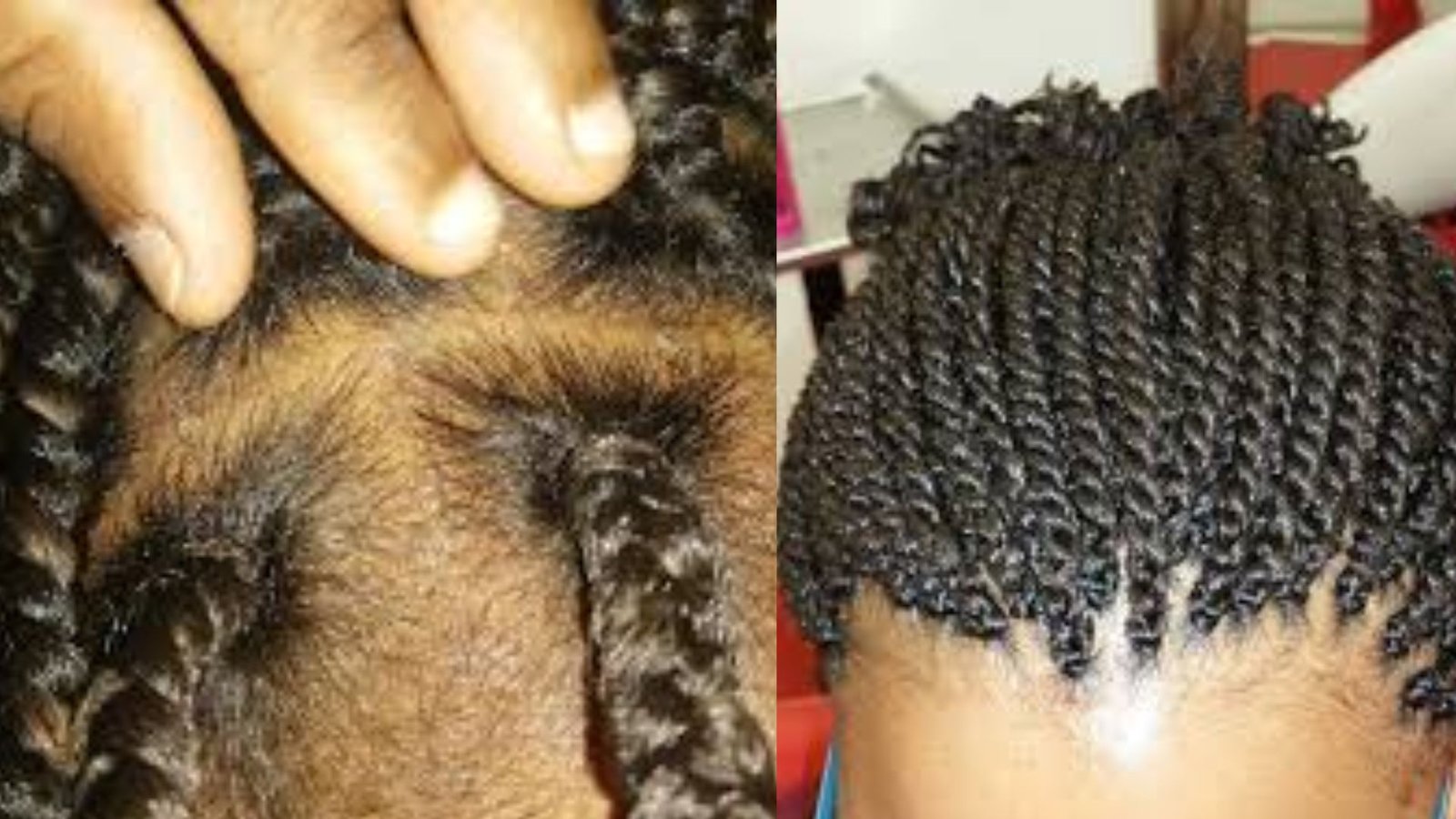 Poor Scalp Hygiene and Product Buildup